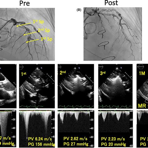 pelliccia lv|Percutaneous transluminal septal myocardial ablation .